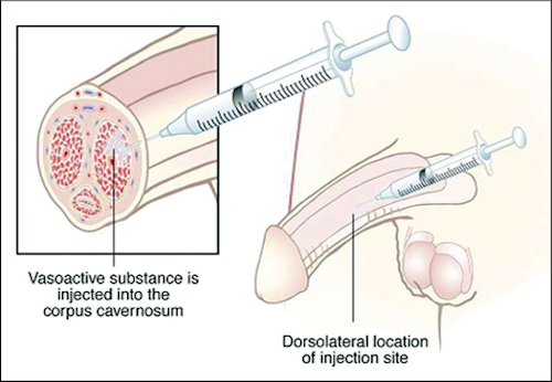Endo's Edex Injection / Image: edguidance.com
