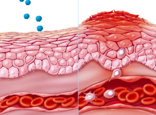 Eczema / Image: ET Healthworld