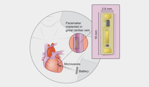 Wireless Pacemaker Diagram / Image: Mehdi Razavi